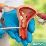 HSG (Histerosalpingografi) Nedir? Nasıl Yapılır?